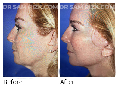 Female face, before and after Facelift and necklift treatment, l-side view, patient 46