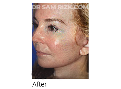 Female face, after Facelift and necklift treatment, oblique view, patient 46