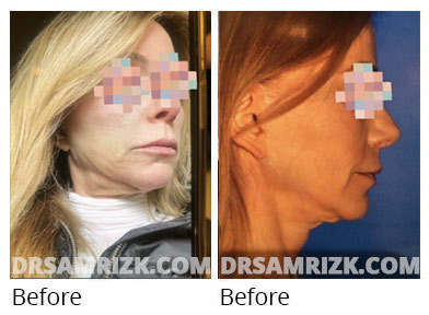 Female face, before and after Facelift and necklift treatment, front view, patient 46