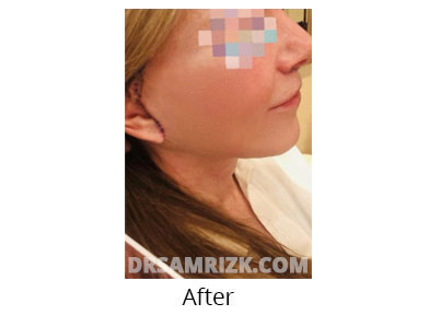 Female face, before and after Facelift and necklift treatment, l-side view, patient 46