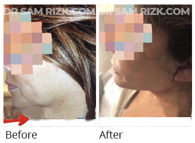 Female face, before and after Facelift and necklift treatment, front view, patient 48