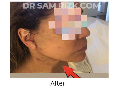 Female face, before and after Facelift and necklift treatment, l-side view, patient 48