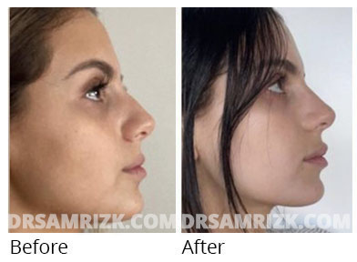 Female face, before and after Rhinoplasty treatment, front view, patient 70