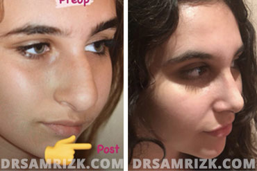 Patient 5 Set1 before and after rhinoplasty