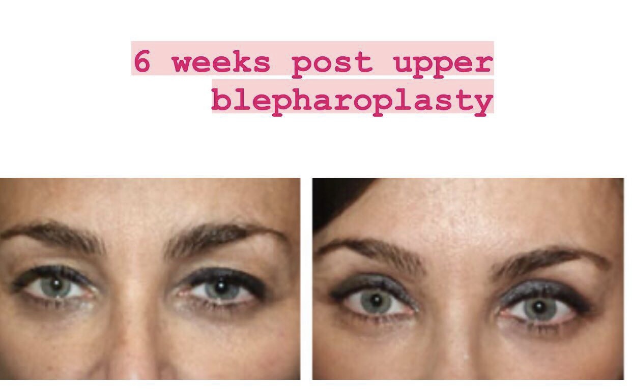 52 yo patient shown 6 weeks after upper blepharoplasty to clean out upper eyelid skin in a natural way