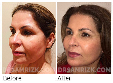 Female face, before and after Facelift, front view, patient 49