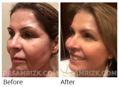 Female face, before and after Facelift, oblique view, patient 49