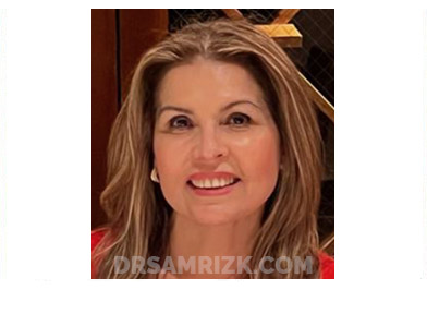 Female face, before and after Facelift, front view, patient 49