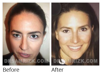 Patient sent her own pictures 6 years after rhinoplasty for bulbous and crooked tip - front views are important to show