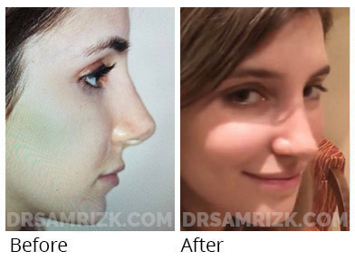 Patient sent her own picture 2 years after revision rhinoplasty to repair upturned nose with cartilage grafts.