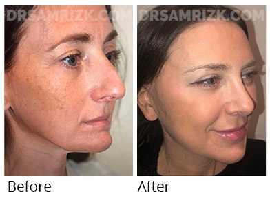 45 yo who felt everything was dropping and nose was getting larger shown 6 months after deep plane facelift rhinoplasty lateral browlift laser.