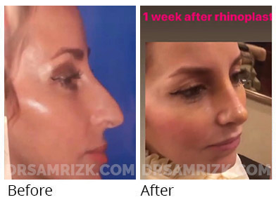 42 yo patient from Spain shown 1 week after rhinoplasty for bump and droppy bulbous tip. Dr RIZk has many international patients.