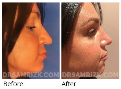 Female face, before and after Rhinoplasty treatment, front view, patient 67