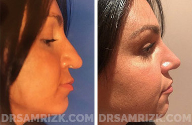 Woman's face, before and after Revision Rhinoplasty treatment, front view