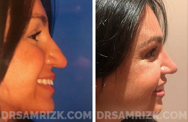 Woman's face, before and after Revision Rhinoplasty treatment, front view