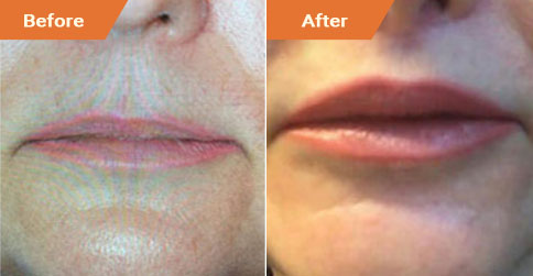 Woman's face, Before and After Lip Enhancement Treatment, lips, front view, patient 3