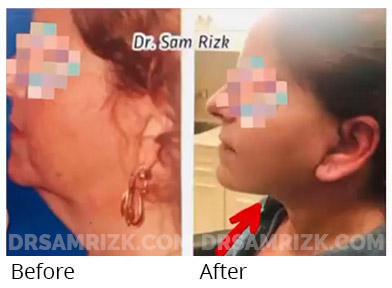55yo shown 1 week after deep plane facelift / deep necklift to show progress and healing. She said her jawline is better than she ever had as a young woman even with swelling.