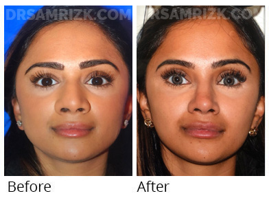 30 yo physician underwent rhinoplasty open with alar base reduction and grafts shown 1 year post, tip and nostrils narrowed and supported and bump removed