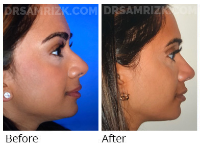 30 yo physician underwent rhinoplasty open with alar base reduction and grafts shown 1 year post, tip and nostrils narrowed and supported and bump removed