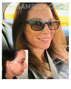 5 th Ave plastic New York plastic surgeon chose Dr Rizk and underwent deep plane facelift / necklift/ browlift and blepharoplasty and sent her picture 3 months post and 6 months post. It's a testament that plastic surgeons chose Dr Rizk for their facelifts.