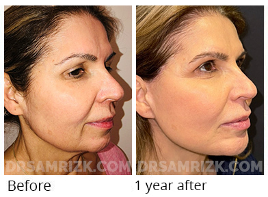 Female face, before and after Facelift, side view, patient 49
