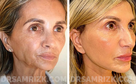 photos Before and After Facelift