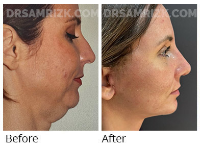 40 yo patient shown 2 weeks after deep plane facelift / deep necklift and rhinoplasty . She looks natural and has a better jawline than she ever had even when she was in her 20’s. Incisions are healing and will continue to improve. Healing varies individually - some patients bruise & swell more than others. No drain was used and tissue sealant was used to reduce bruising and swelling.