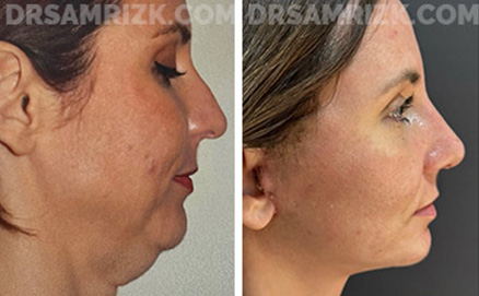 40 yo patient shown 2 weeks after deep plane facelift / deep necklift and rhinoplasty . She looks natural and has a better jawline than she ever had even when she was in her 20’s. Incisions are healing and will continue to improve. Healing varies individually - some patients bruise & swell more than others. No drain was used and tissue sealant was used to reduce bruising and swelling.