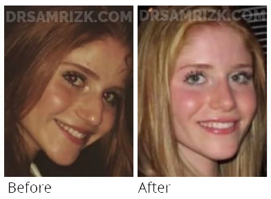 Patient sent her postop pictures 2 years after rhinoplasty compared to same time before.