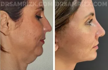 Jennifer Fessler face, before and after Facelift Surgery, front view