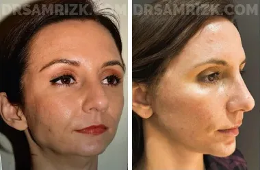 Jennifer Fessler face, before and after Facelift Surgery, l-side oblique view