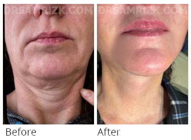 55 yo deep plane facelift / deep necklift patient 1 week post