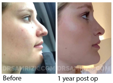 Female face, before and after Rhinoplasty treatment, side view, patient 42