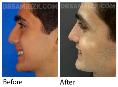 Teenage patient underwent conservative septoplasty/ rhinoplasty to remove bump and repair breathing