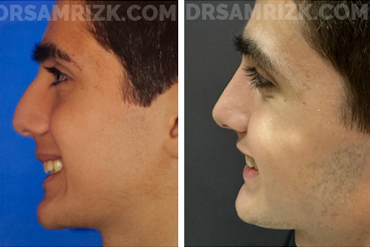 Patient 5 Set1 before and after rhinoplasty