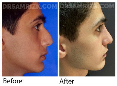 Teenage patient underwent conservative septoplasty/ rhinoplasty to remove bump and repair breathing