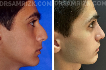 Patient 5 Set1 before and after rhinoplasty