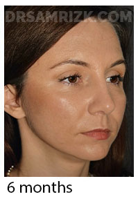 40 yo patient shown 2 weeks after deep plane facelift / deep necklift and rhinoplasty . She looks natural and has a better jawline than she ever had even when she was in her 20’s. Incisions are healing and will continue to improve. Healing varies individually - some patients bruise & swell more than others. No drain was used and tissue sealant was used to reduce bruising and swelling.