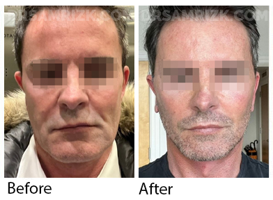 55 yo male sent his own pictures at 3 days post revision deep plane facelift / deep necklift / midline platysmaplasty . Patient shown on video at 1 week post . Previous failed smas lift was done 1 year prior.