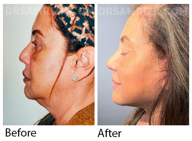 55 yo female patient shown 6 months after deep plane facelift / deep neck lift and laser resurfacing. Most of her neck fat was under muscle requiring a deep neck lift