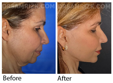 65 yo patient shown 1 year post deep plane facelift/deep necklift