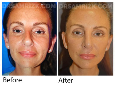 55 yo patient shown 6 months after deep plane facelift /deep necklift / midline platysmaplasty / fat transfer to lower eyes and rhinoplasty.