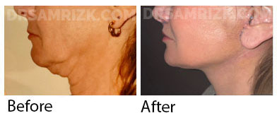 This patient is shown 2 weeks after deep plane facelift / deep necklift / midline platysmaplasty.