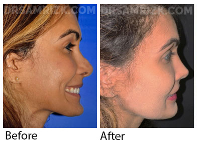 This is a patient who underwent revision rhinoplasty with MtF rib bank cartilage and fascia, shown 6 months post-surgery. Issues repaired include: Open roof deformity, Crookedness, Pollybeak deformity and Inverted V deformity