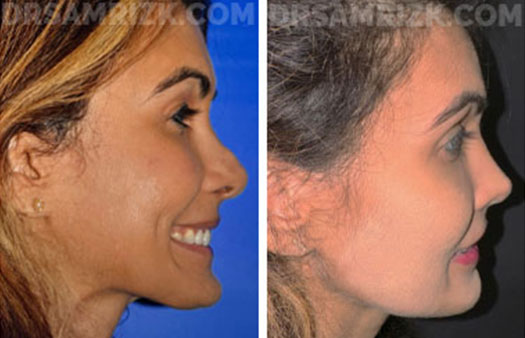 This is a patient who underwent revision rhinoplasty with MtF rib bank cartilage and fascia, shown 6 months post-surgery. Issues repaired include: Open roof deformity, Crookedness, Pollybeak deformity and Inverted V deformity