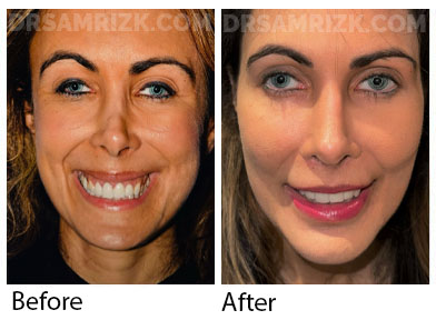 This is a patient who underwent revision rhinoplasty with MtF rib bank cartilage and fascia, shown 6 months post-surgery. Issues repaired include: Open roof deformity, Crookedness, Pollybeak deformity and Inverted V deformity