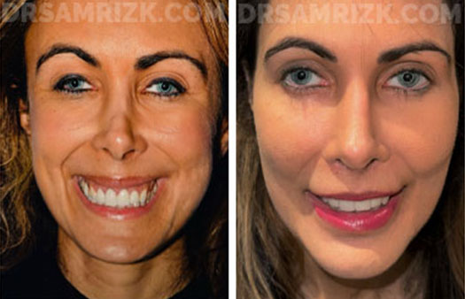 This is a patient who underwent revision rhinoplasty with MtF rib bank cartilage and fascia, shown 6 months post-surgery. Issues repaired include: Open roof deformity, Crookedness, Pollybeak deformity and Inverted V deformity