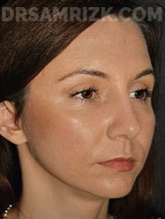 Jennifer Fessler face, before and after Facelift Surgery, l-side oblique view