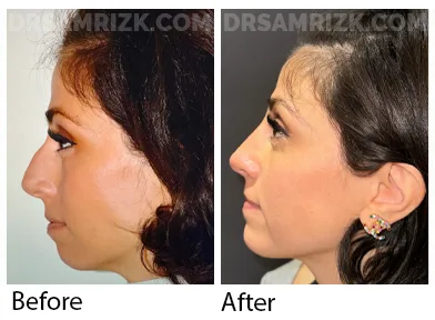 Patient is 4 months after rhinoplasty / chin implant. Note jawline / nose balance by removing bump and augmenting chin creating a better jawline.