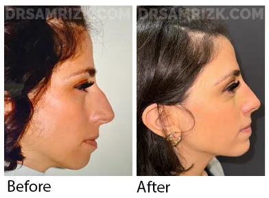 Patient is 4 months after rhinoplasty / chin implant. Note jawline / nose balance by removing bump and augmenting chin creating a better jawline.